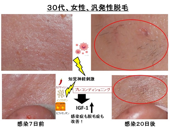 円形脱毛症　病院